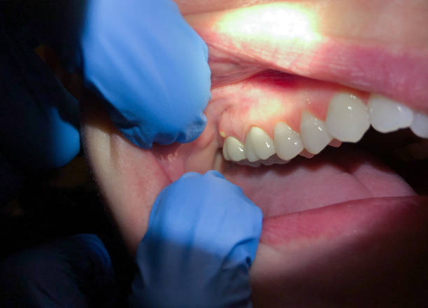 Best Urgent Care for Lost Fillings or Crowns in Elverson, PA